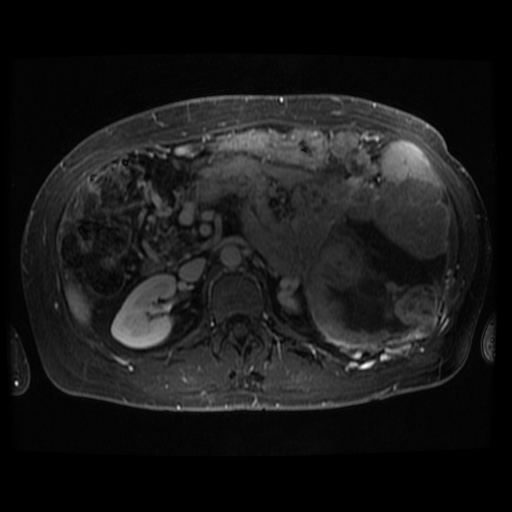 Acinar cell carcinoma of the pancreas (Radiopaedia 75442-86668 D 46).jpg