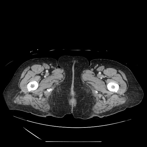 Acinar cell carcinoma of the pancreas (Radiopaedia 75442-86669 Axial C+ portal venous phase 163).jpg