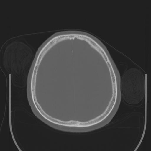 File:Acoustic schwannoma (Radiopaedia 29488-29982 AXIAL BONE THICK non-contrast 38).jpg