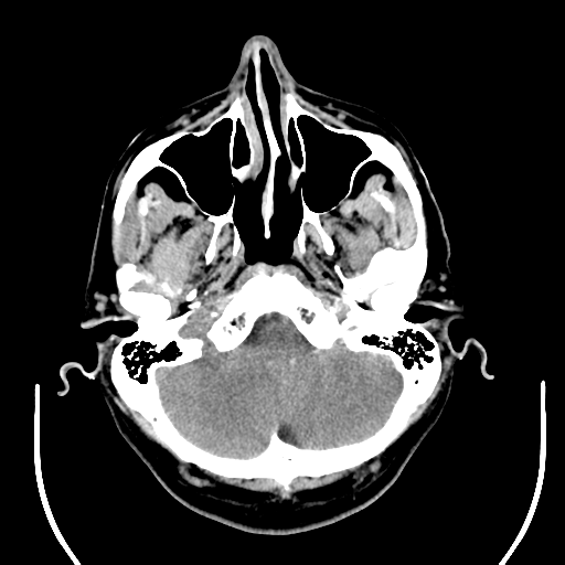 File:Acoustic schwannoma (Radiopaedia 39170-41388 Axial non-contrast 8).png