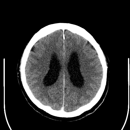 File:Acoustic schwannoma (Radiopaedia 39170-41389 Axial C+ 19).png
