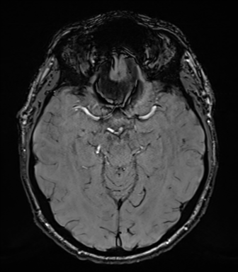 File:Acoustic schwannoma (Radiopaedia 50846-56358 Axial SWI 38).png