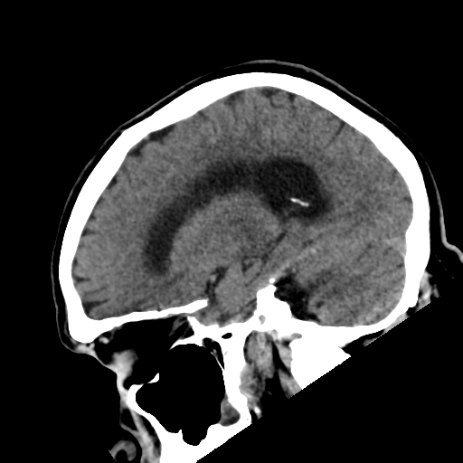 File:Acoustic schwannoma (Radiopaedia 55729-62280 Sagittal non-contrast 12).png