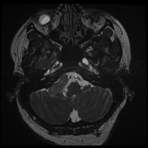 Acoustic schwannoma (Radiopaedia 57574-64536 Axial T2 15).png
