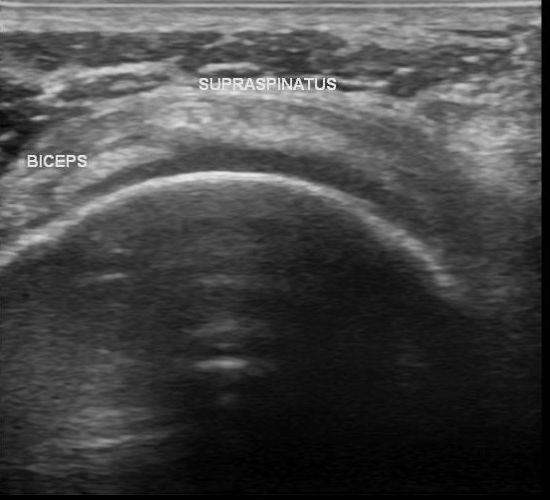 File:Acromial fracture - ultrasound (Radiopaedia 26729-26891 E 1).jpg