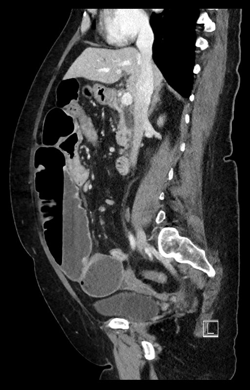 Active Crohn disease (Radiopaedia 59394-66750 Sagittal C+ portal venous phase 34).jpg