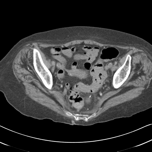 File:Active bleeding from duodenal ulcer with embolization (Radiopaedia 34216-35481 Axial non-contrast 56).png