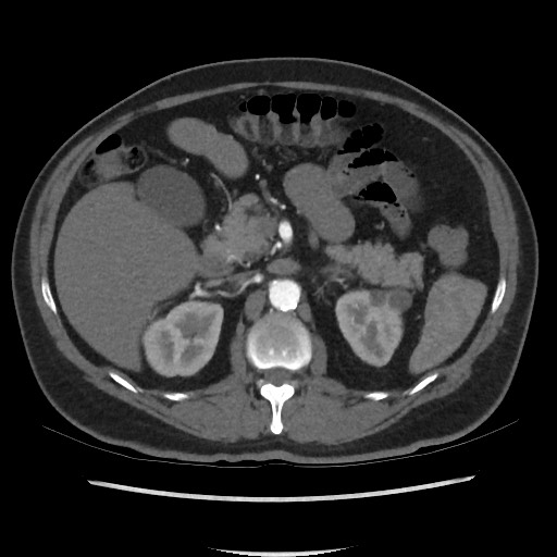 Active colonic bleed on CT (Radiopaedia 49765-55025 Axial C+ arterial phase 29).jpg