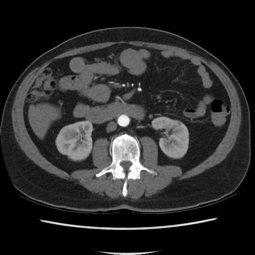 Active colonic bleed on CT (Radiopaedia 49765-55025 Axial C+ arterial phase 39).jpg