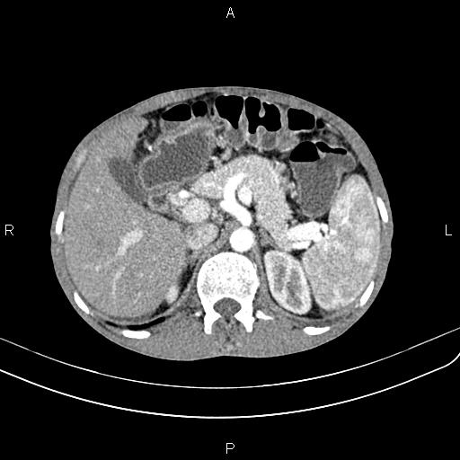 File:Active crohn disease (Radiopaedia 87133-103397 Axial C+ arterial phase 32).jpg