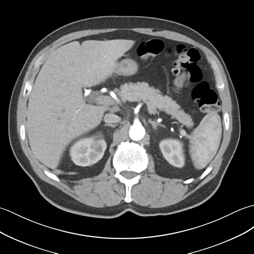 Active diverticular hemorrhage (Radiopaedia 39415-41725 Axial C+ arterial phase 18).png