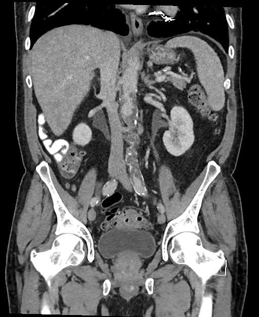 Active lower gastrointestinal bleeding - diverticular (Radiopaedia 61203-69106 Coronal C+ portal venous phase 75).jpg