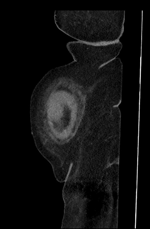Active renal extravasation with large subcapsular and retroperitoneal hemorrhage (Radiopaedia 60975-68796 Sagittal C+ portal venous phase 204).jpg