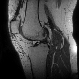 Acute-on-chronic transient lateral patellar dislocation with trochlear dysplasia (Radiopaedia 84099-99349 Sagittal PD 90).jpg