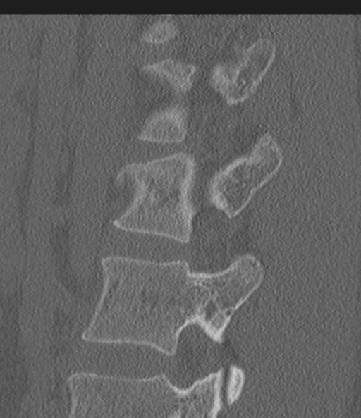 Acute L1 burst compression fracture (Radiopaedia 34430-35755 Sagittal bone window 45).png