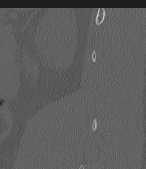 Acute L1 burst compression fracture (Radiopaedia 34430-35755 Sagittal bone window 59).png