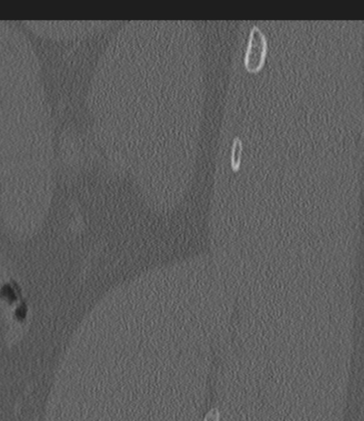 Acute L1 burst compression fracture (Radiopaedia 34430-35755 Sagittal bone window 62).png