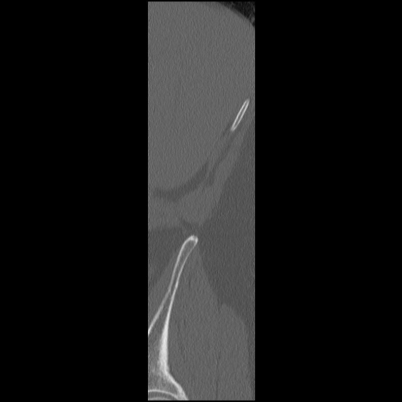 Acute Schmorl's node (Radiopaedia 83276-102365 Sagittal bone window 88).jpg