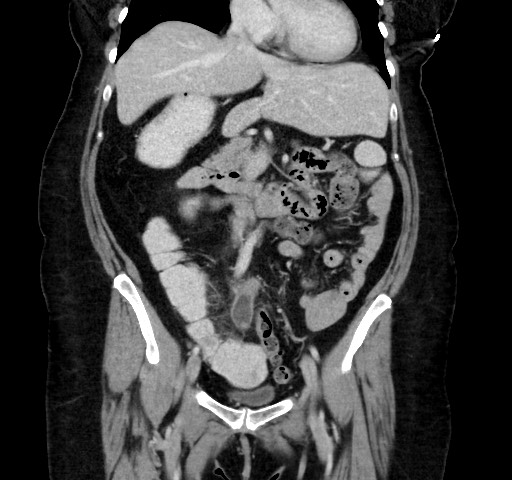 Acute appendicitis, heterotaxy syndrome (Radiopaedia 66884-76202 Coronal C+ portal venous phase 54).jpg