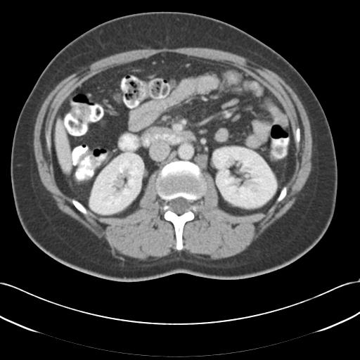 File:Acute appendicitis (Radiopaedia 30297-30934 Axial C+ portal venous phase 35).jpg