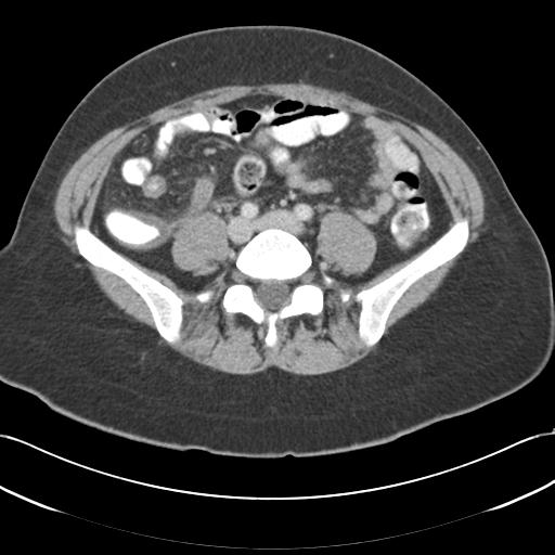 File:Acute appendicitis (Radiopaedia 30297-30934 Axial C+ portal venous phase 54).jpg