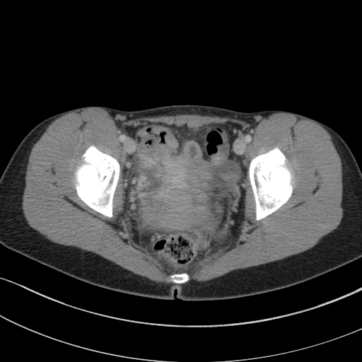 Acute appendicitis (Radiopaedia 62608-70901 Axial C+ portal venous phase 47).jpg