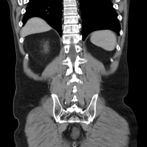 Acute appendicitis (Radiopaedia 66513-75790 Coronal C+ portal venous phase 74).jpg