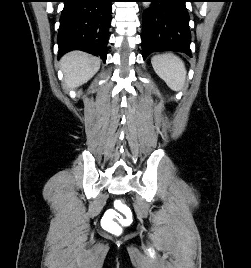 Acute appendicitis (Radiopaedia 77016-88960 Coronal C+ portal venous phase 78).jpg