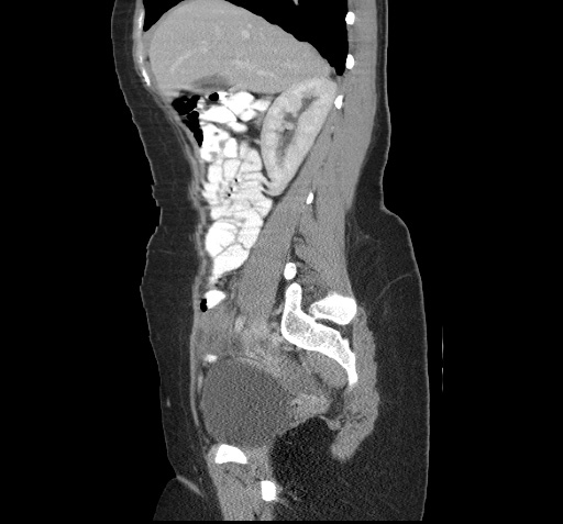 File:Acute appendicitis (Radiopaedia 9417-10099 Sagittal C+ portal venous phase 10).jpg