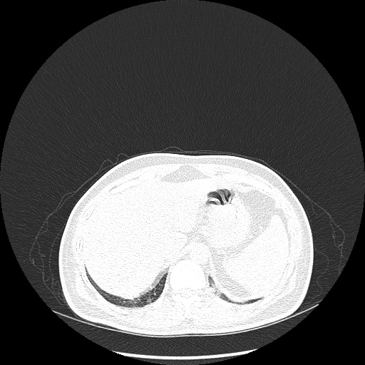 Acute appendicitis and COVID 19 pneumonia (Radiopaedia 76604-88380 Axial lung window 52).jpg