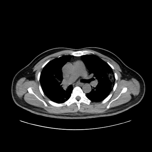 File:Acute appendicitis and COVID 19 pneumonia (Radiopaedia 76604-88380 Axial non-contrast 24).jpg