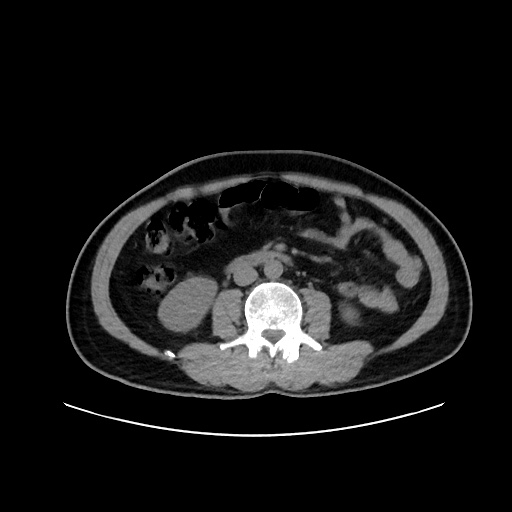 Acute appendicitis and COVID 19 pneumonia (Radiopaedia 76604-88380 Axial non-contrast 78).jpg
