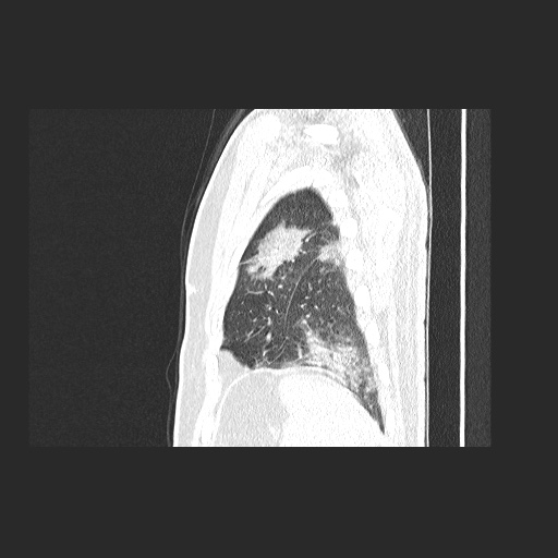 Acute appendicitis and COVID 19 pneumonia (Radiopaedia 76604-88380 Sagittal lung window 81).jpg