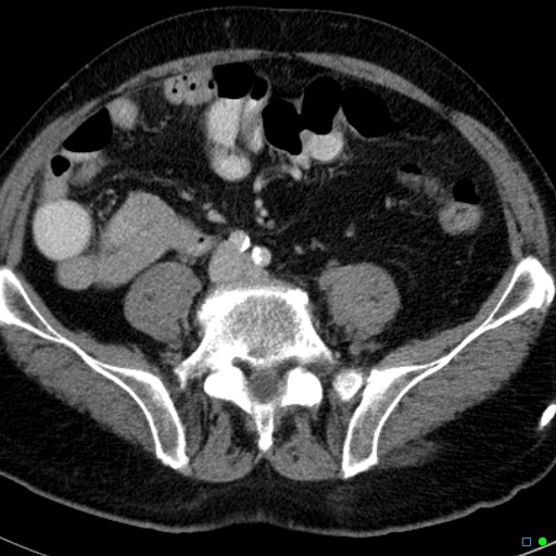 File:Acute appendicitis arising from a malrotated cecum (Radiopaedia 19970-19997 Axial C+ portal venous phase 26).jpg