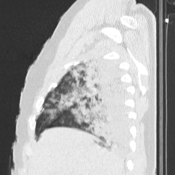 Acute aspiration pneumonitis (Radiopaedia 33605-34703 Sagittal lung window 20).jpg