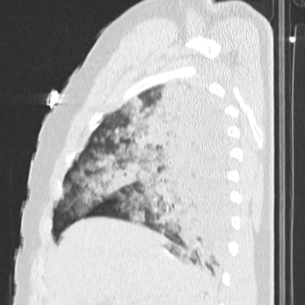 Acute aspiration pneumonitis (Radiopaedia 33605-34703 Sagittal lung window 25).jpg