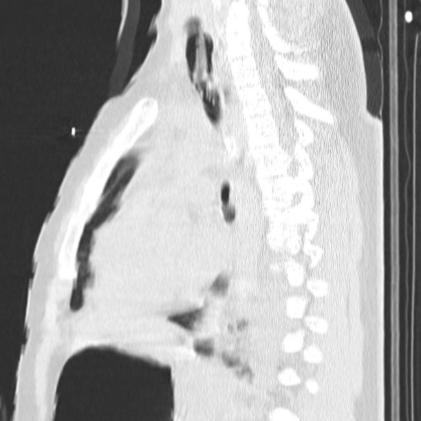 Acute aspiration pneumonitis (Radiopaedia 33605-34703 Sagittal lung window 49).jpg