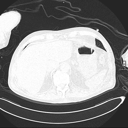 Acute aspiration pneumonitis (Radiopaedia 55642-62166 Axial lung window 140).jpg