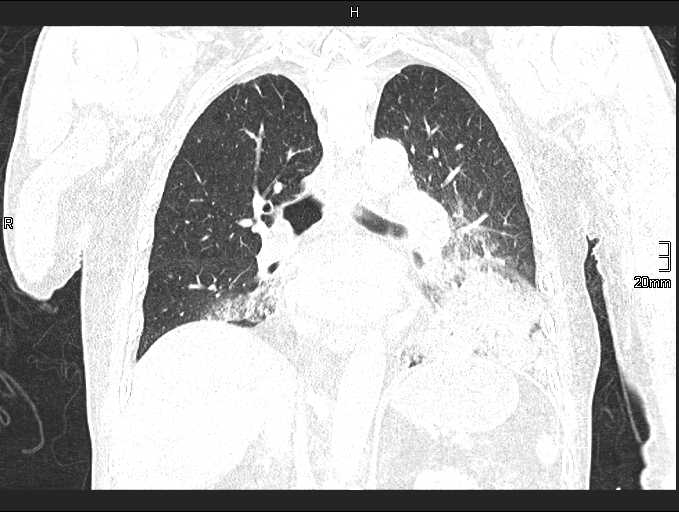 Acute aspiration pneumonitis (Radiopaedia 55642-62166 Coronal lung window 61).jpg