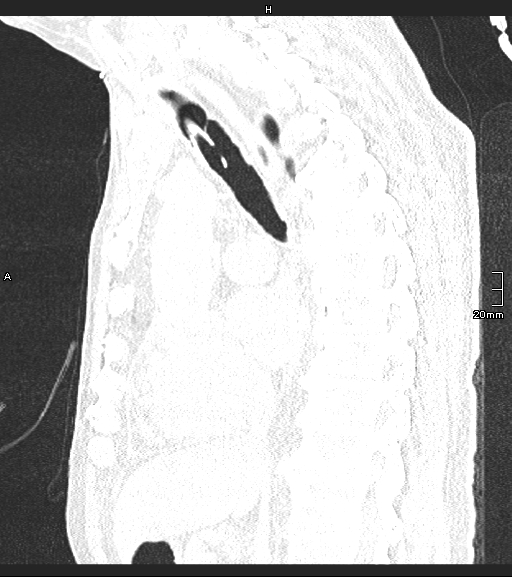 File:Acute aspiration pneumonitis (Radiopaedia 55642-62166 Sagittal lung window 81).jpg