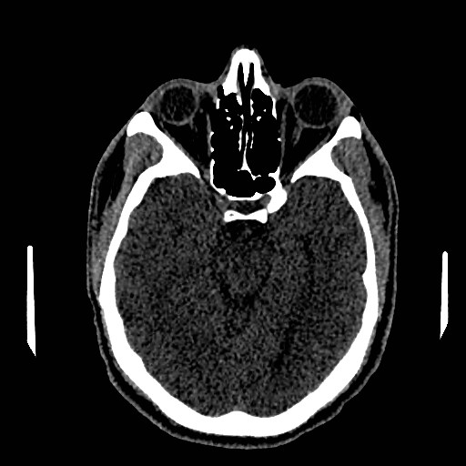 Acute basilar artery occlusion (Radiopaedia 43582-46985 Axial non-contrast 77).jpg