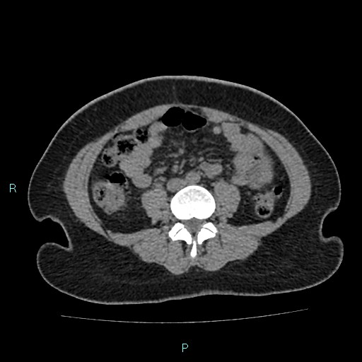 File:Acute bilateral pyelonephritis (Radiopaedia 37146-38881 Axial non-contrast 63).jpg