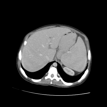 Acute calculous cholecystitis in patient with osteopetrosis (Radiopaedia 77871-90159 Axial C+ portal venous phase 23).jpg