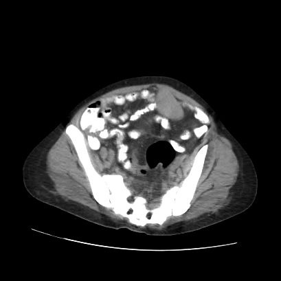 File:Acute calculous cholecystitis in patient with osteopetrosis (Radiopaedia 77871-90159 Axial non-contrast 64).jpg