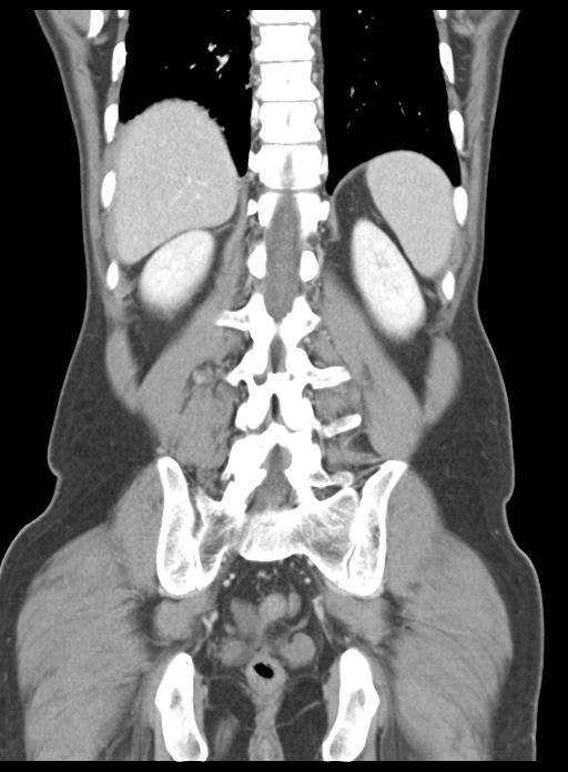 Acute cholecystitis (Radiopaedia 29814-30327 Coronal C+ portal venous phase 40).jpg