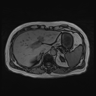 Acute cholecystitis (Radiopaedia 72392-82923 Axial T1 out-of-phase 39).jpg