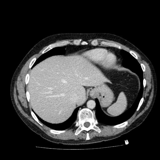 Acute cholecystitis and incidental left sided IVC (Radiopaedia 49352-54459 Axial C+ portal venous phase 31).jpg