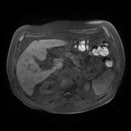 Acute cholecystitis complicated by pylephlebitis (Radiopaedia 65782-74915 Axial T1 fat sat 48).jpg