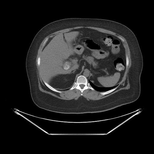 Acute cholecystitis with tensile fundus sign (Radiopaedia 71394-81723 Axial non-contrast 12).jpg