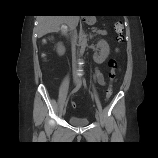 Acute cholecystitis with tensile fundus sign (Radiopaedia 71394-81723 Coronal non-contrast 69).jpg
